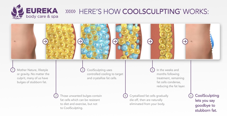 How CoolSculpting works