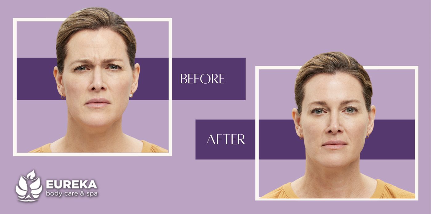 Botox before and after results at Eureka Body Care & Spa