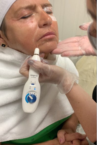 Fibroblast plasma skin tightening treatment being performed at Eureka Body Care and Spa